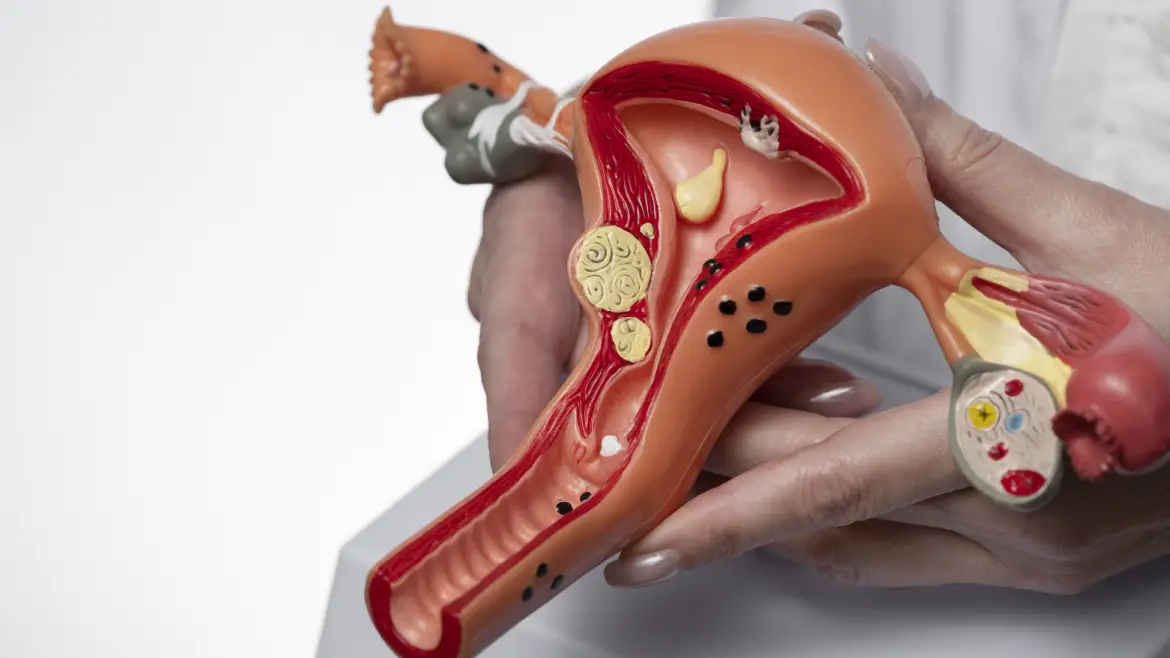 Polikistik Over (PCOS)